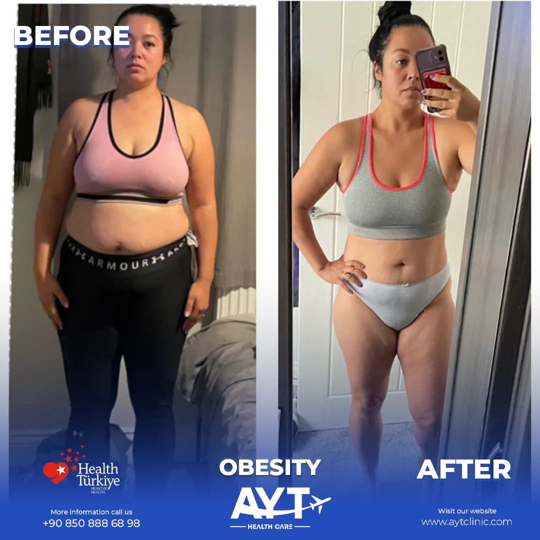 Who Is Suitable for Weight Loss Surgery in Turkey?