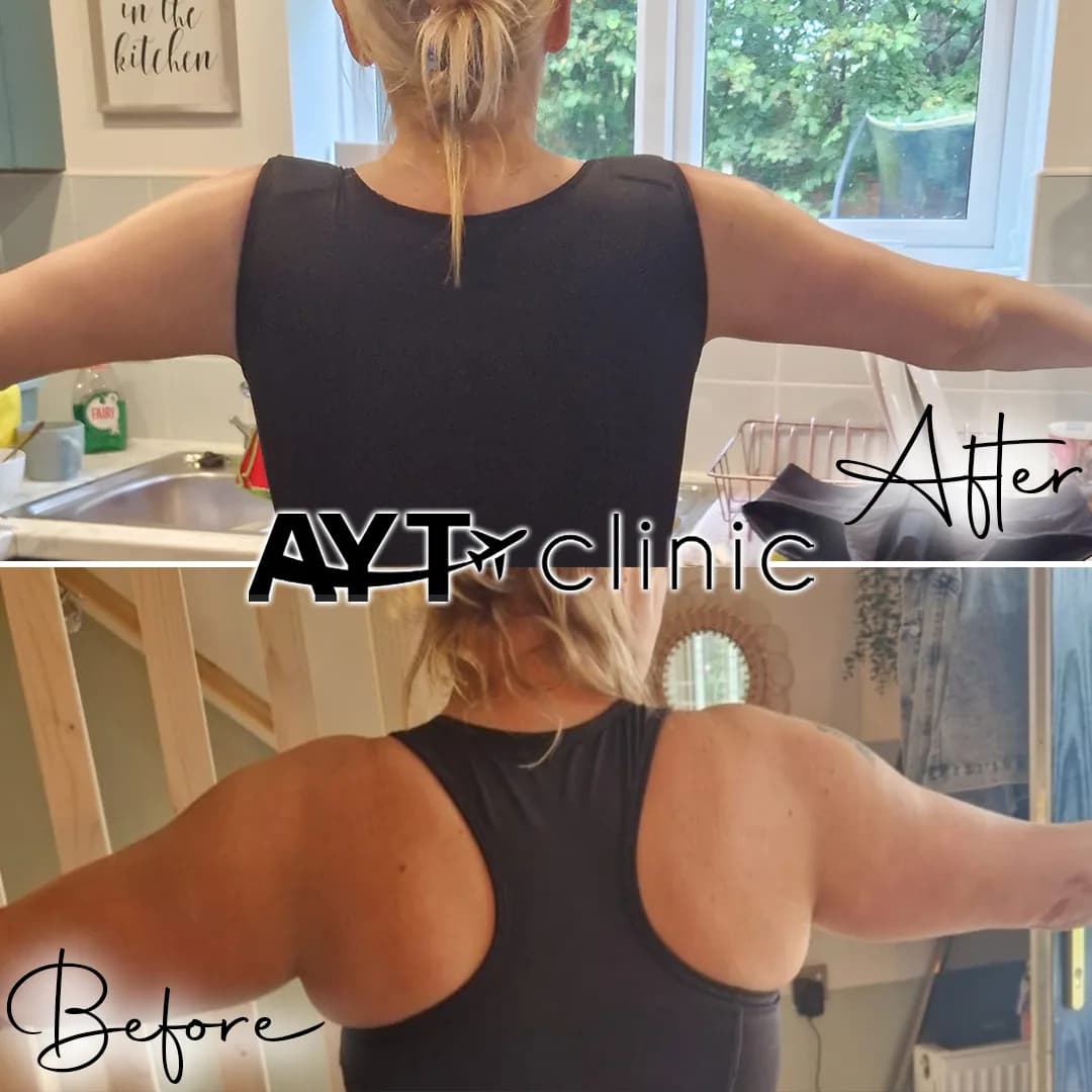 Before and after result