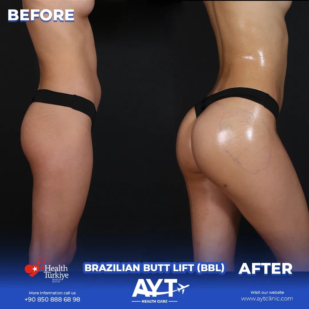 Before and after result