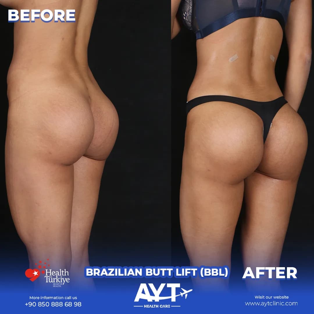 Before and after result