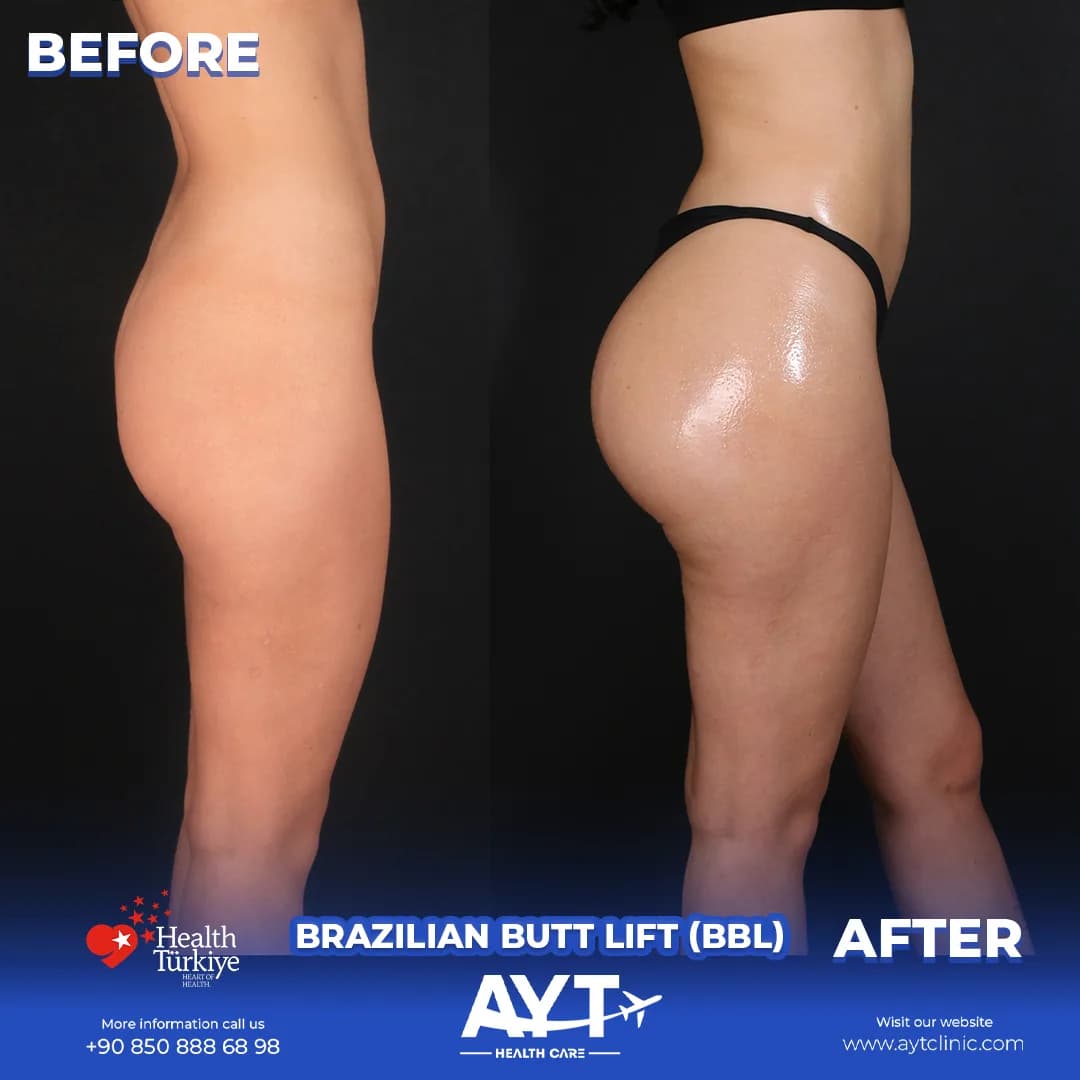 Before and after result