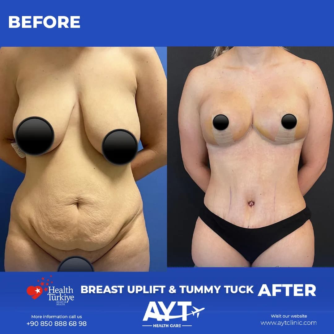 Before and after result